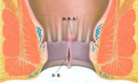 肛裂