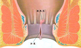 肛裂