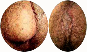 前庭大腺囊肿