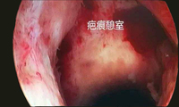 剖宫产瘢痕妊娠