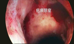 剖宫产瘢痕妊娠