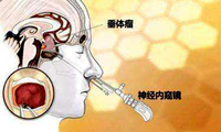 垂体瘤