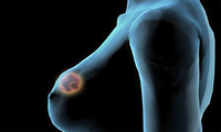 乳腺结核