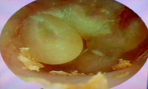 大疱性鼓膜炎