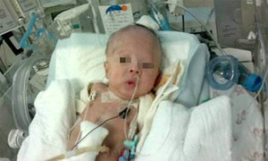 先天性食管闭锁