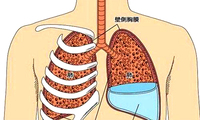 类肺炎性胸腔积液