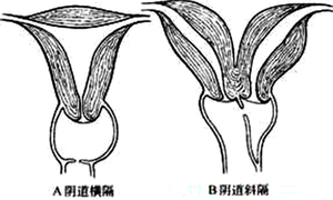 阴道斜隔