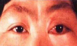眼眶骨化纤维瘤