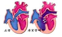 房室管畸形