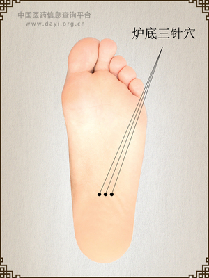炉底三针穴